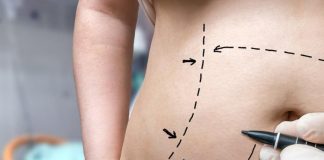 Liposuction vs Tummy Tuck: What’s the Difference?