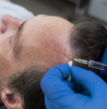 Hair Transplant in Turkey: Why It’s Becoming a Popular Choice for International Patients